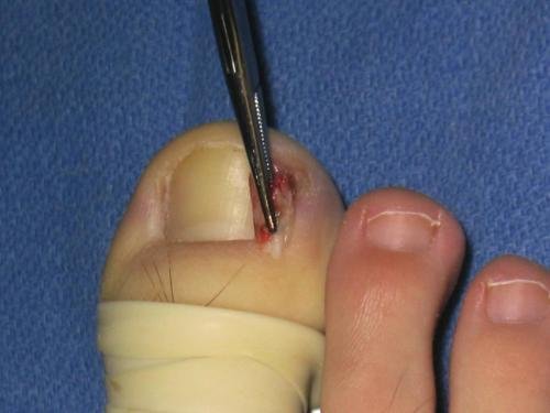 NAIL SURGERY
