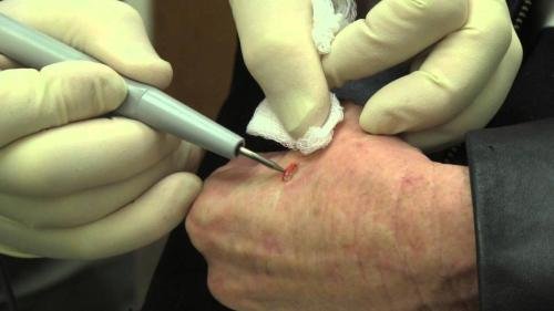 RF CAUTERY